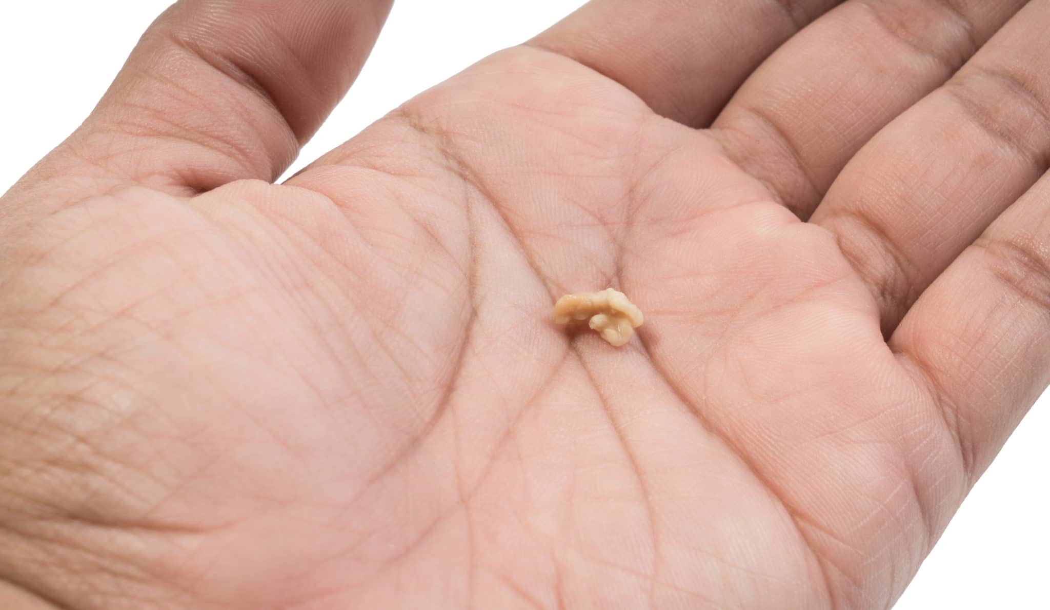 a tonsil stone in a person's hand