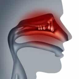 Nasal polyps illustration