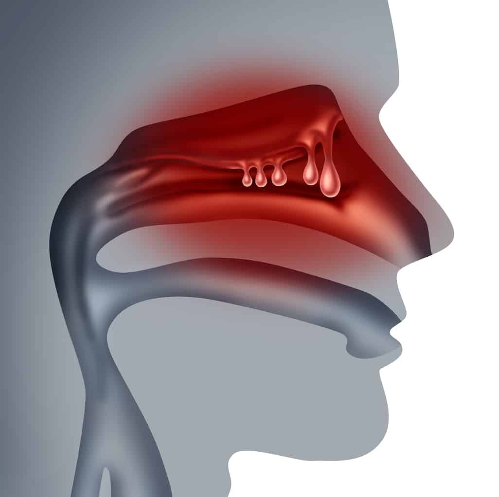 Nasal polyps situation.